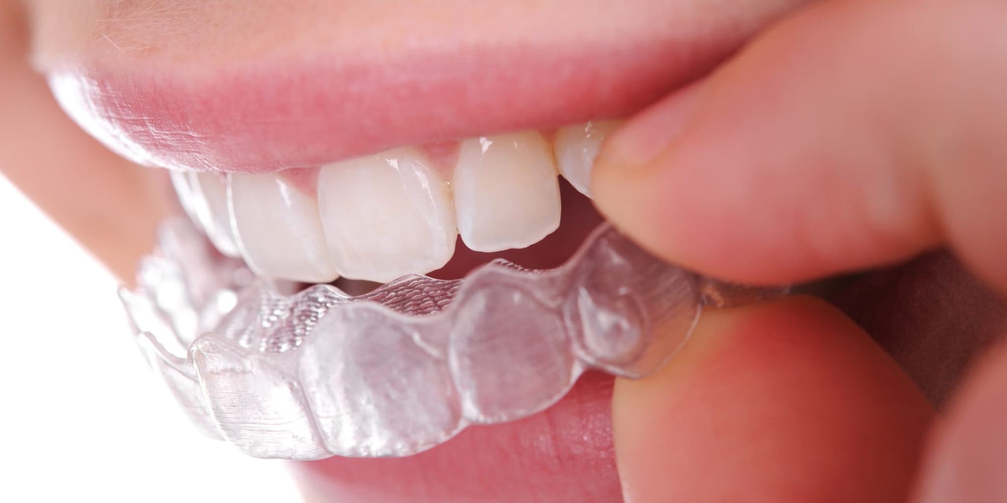 Smile Saver: Wie Zahnschienen Schäden vorbeugen und das Mundwohl verbessern können