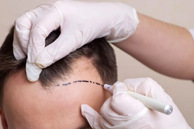 Haartransplantationsverfahren und Kosten